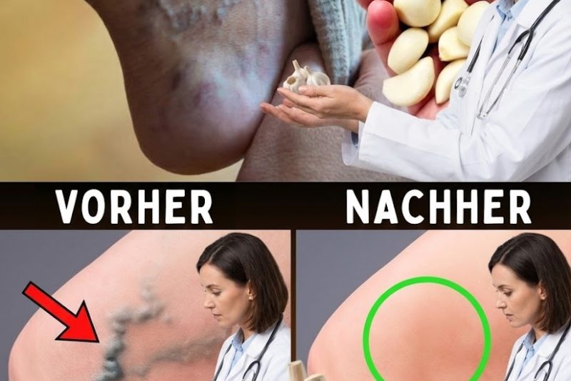 💥 Das Wunder des Knoblauchs: Wie Dieses Einfache Hausmittel Natürlich Gegen Krampfadern Helfen Kann