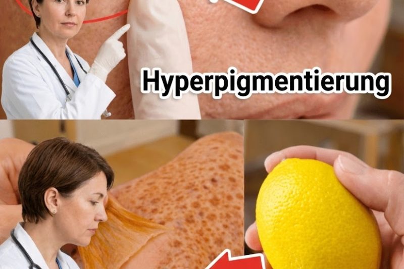 Wie man Altersflecken auf natürliche Weise mit Zitronensaft verblassen lässt: Eine sanfte Haus‑Methode