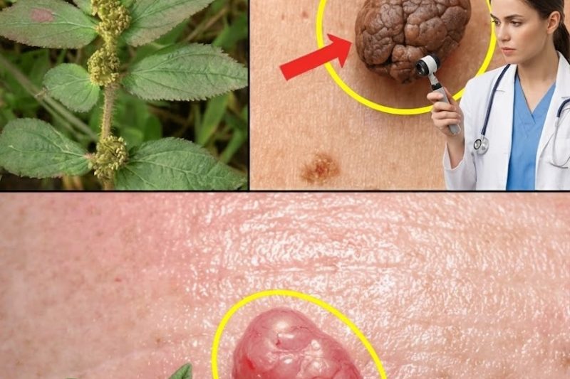 7 Abordagens Naturais Que Podem Ajudar no Manejo de Verrugas e no Conforto da Pele