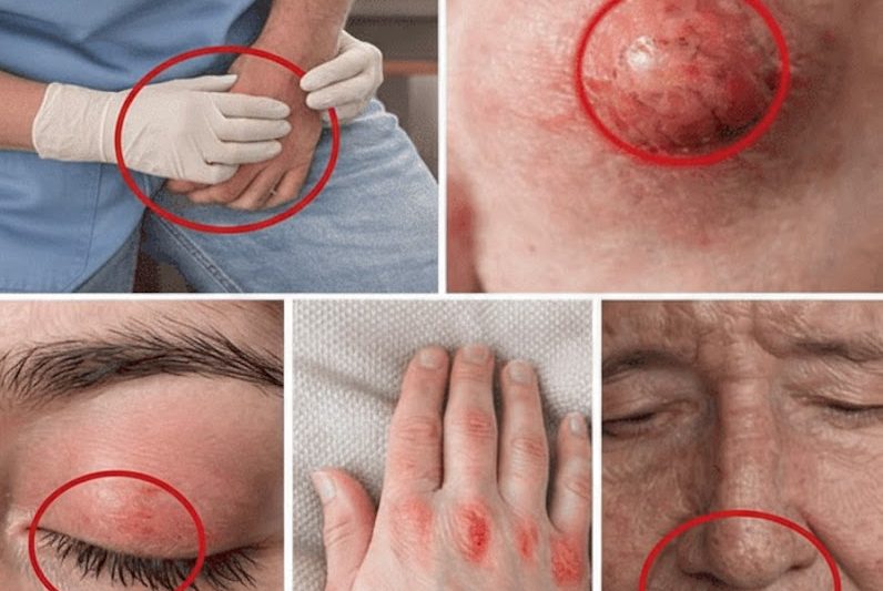 10 Sinais Sutis de Câncer de Cólon e Passos Simples Para Perceber Mais Cedo