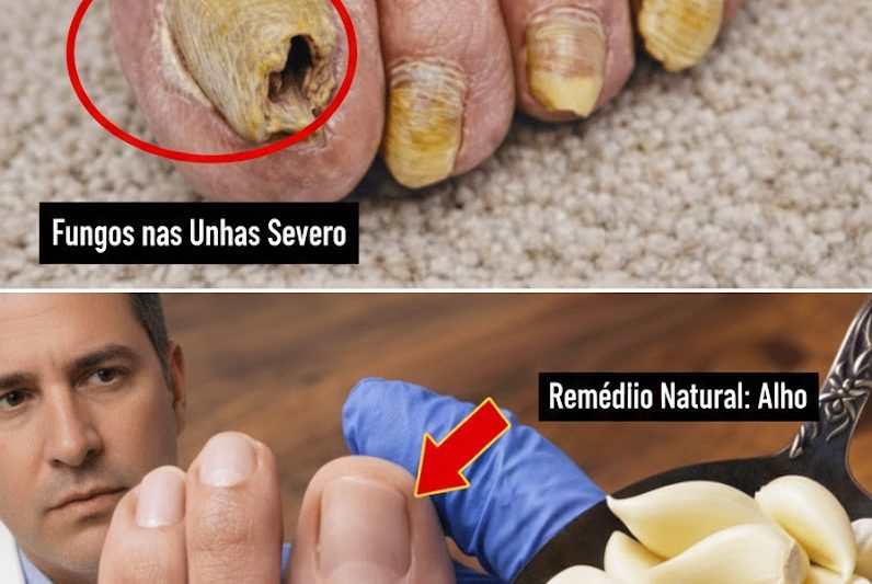 O Truque do Alho Que Pode Ajudar a Cuidar da Saúde das Unhas dos Pés