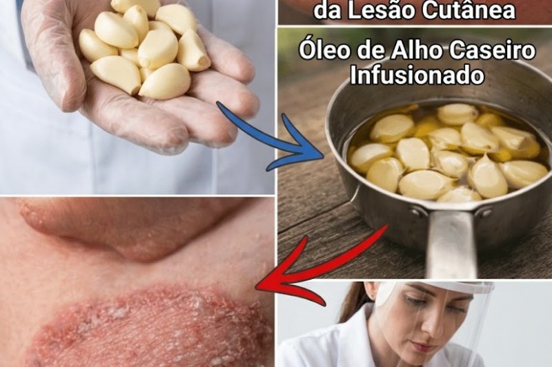 Alho e Azeite de Oliva: Uma Abordagem Tradicional para Acalmar o Desconforto da Pele com Fungos de Forma Natural