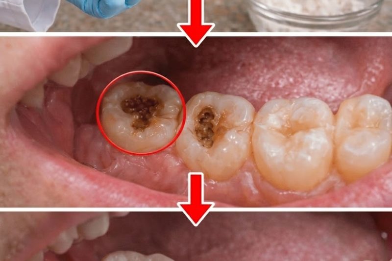 Dicas Naturais Simples para Manter os Dentes Saudáveis: 5 Remédios Caseiros Poderosos que Podem Ajudar a Prevenir Cáries e Reduzir Visitas ao Dentista