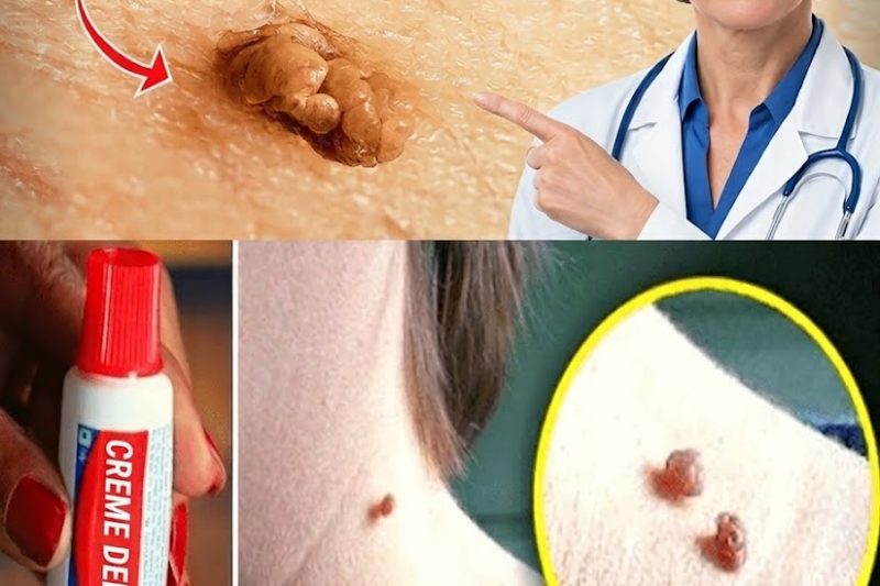 Elimine Acrocórdons Durante a Noite com Vaselina: O Segredo da Pele que Quase Ninguém Conta