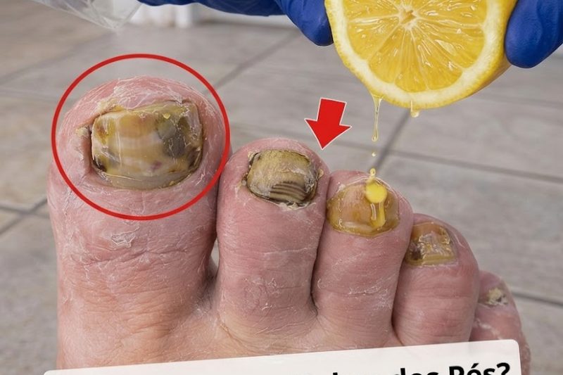 O Limão Pode Ajudar a Combater Fungos? Experimente Esta Receita Natural Simples