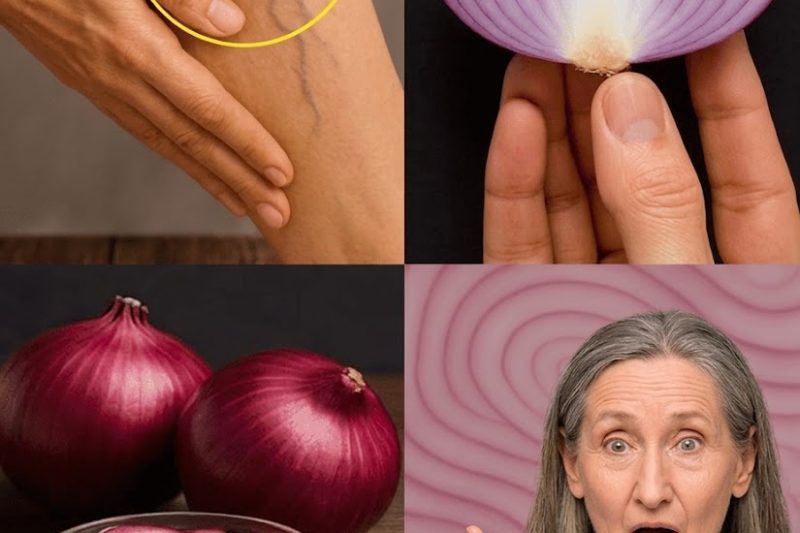 Cebola Roxa para Varizes: Um Remédio Natural que Pode Ajudar a Aliviar as Pernas Cansadas