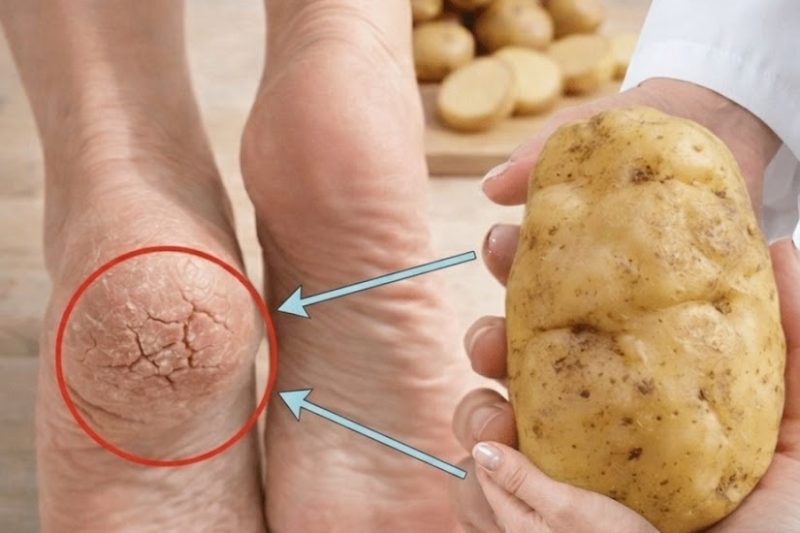 Suco de Batata: Um Remédio Simples da Cozinha Que Pode Aliviar Pernas Cansadas e Pesadas
