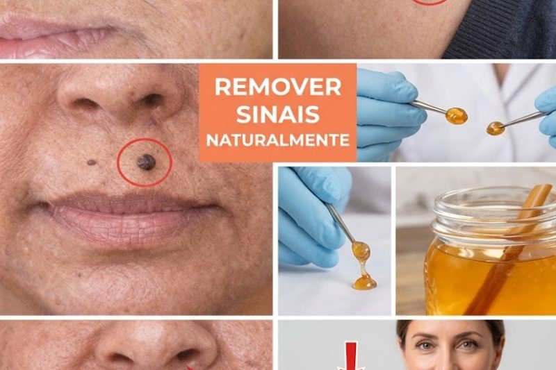 Como Remover Verrugas em Casa com Segurança – Métodos Realistas que Muitas Pessoas Usam