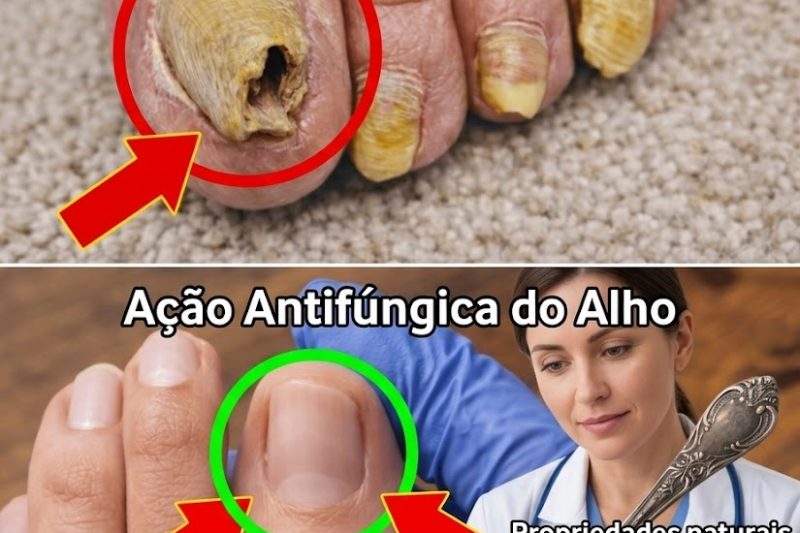O Truque do Alho Que Pode Ajudar a Melhorar a Saúde das Suas Unhas dos Pés