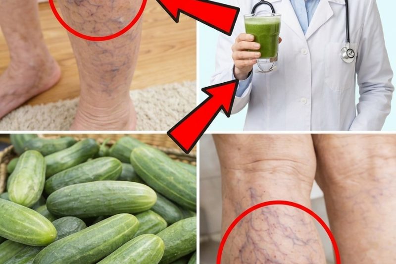 Poucos Sabem: Este Vegetal Comum Pode Ajudar a Aliviar os Sintomas das Varizes