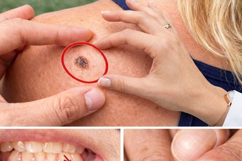 14 Sinais de Alerta de Câncer que Você Nunca Deve Ignorar