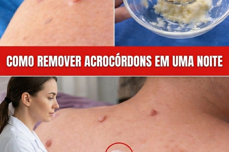 Como Remover Acrocórdons Naturalmente em Uma Noite em Casa (Sim, Até com Algo Simples como Vaselina)